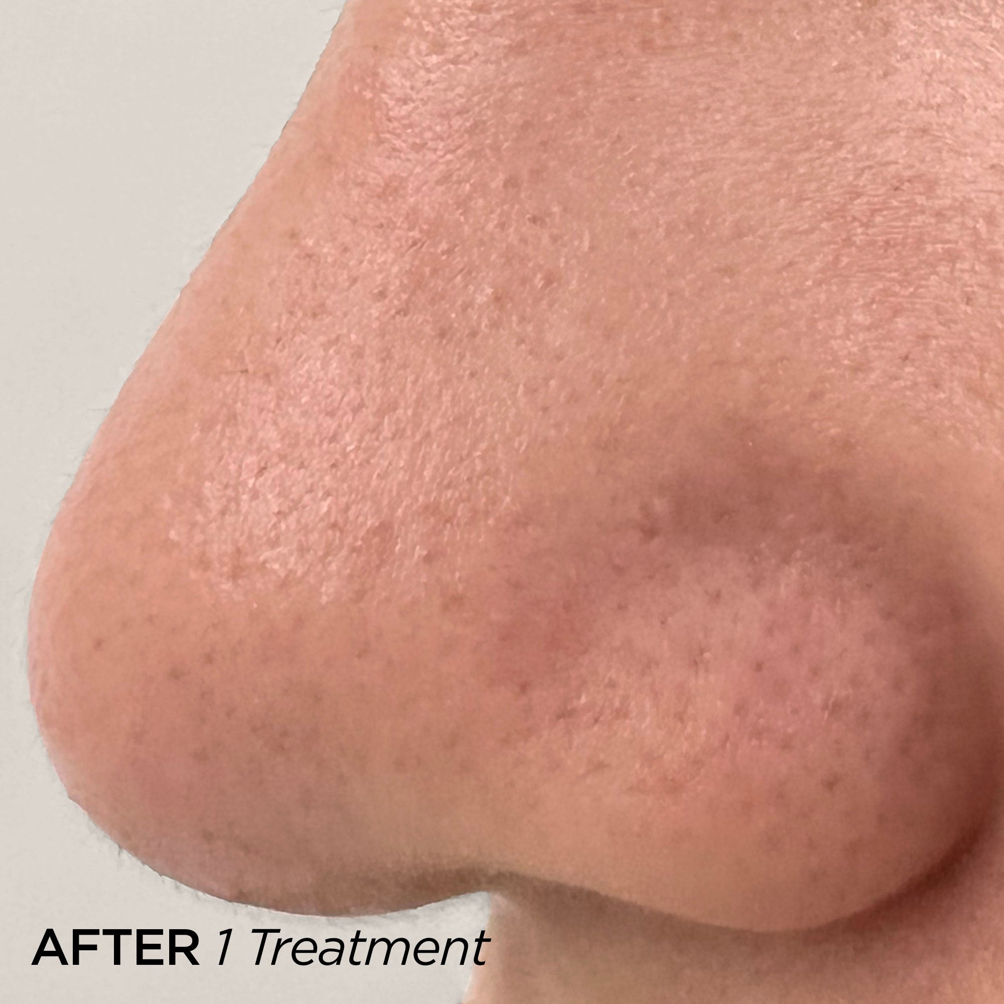 After 1 Treatment of GLOfacial